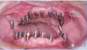 dental implants in ahmedabad