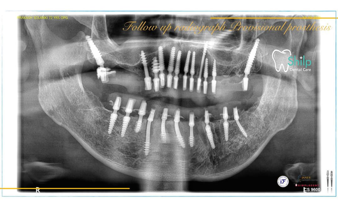 dental implant in ahmedabad