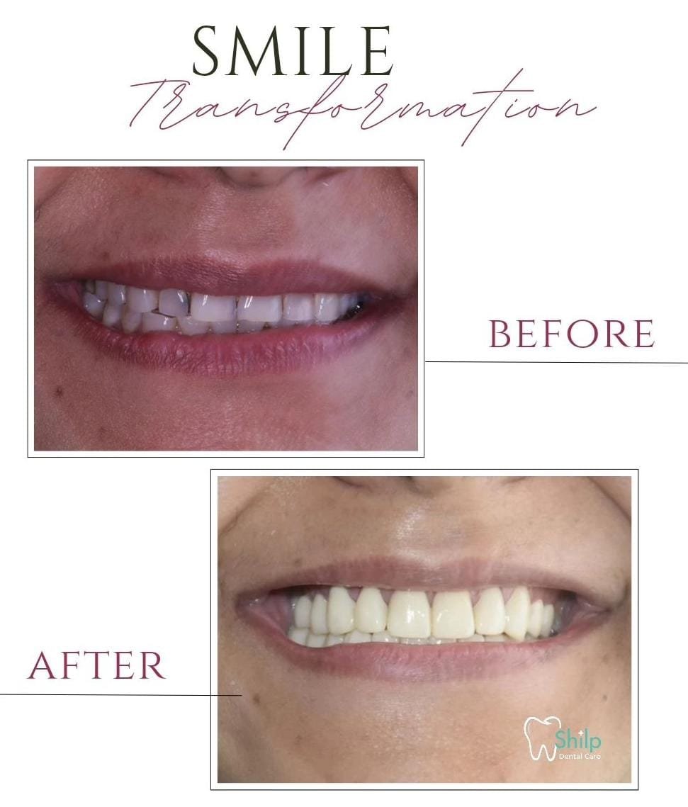 cosmetic dentistry before after