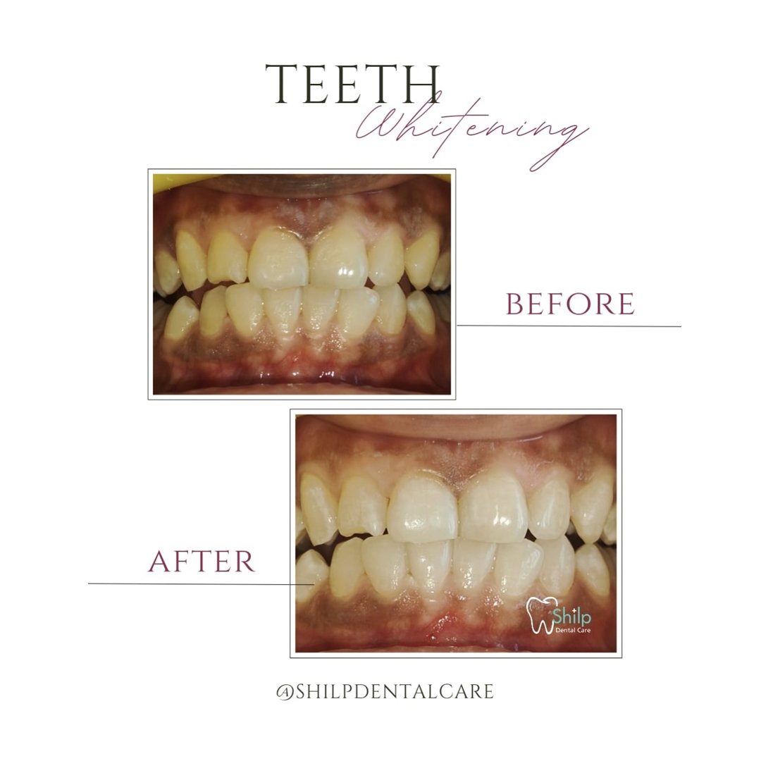 Teeth Whitening Before and After 1