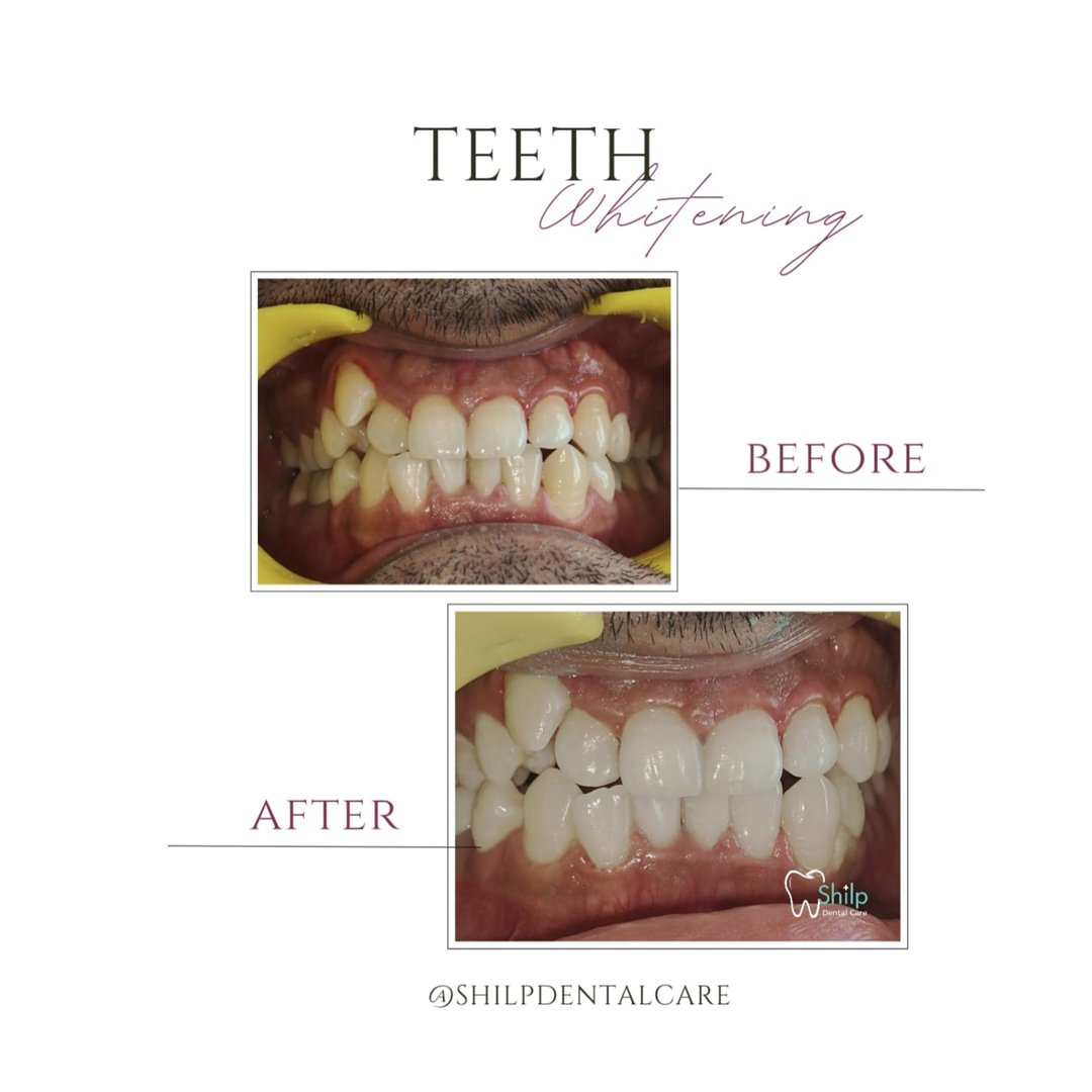 Teeth Whitening Before and After 2