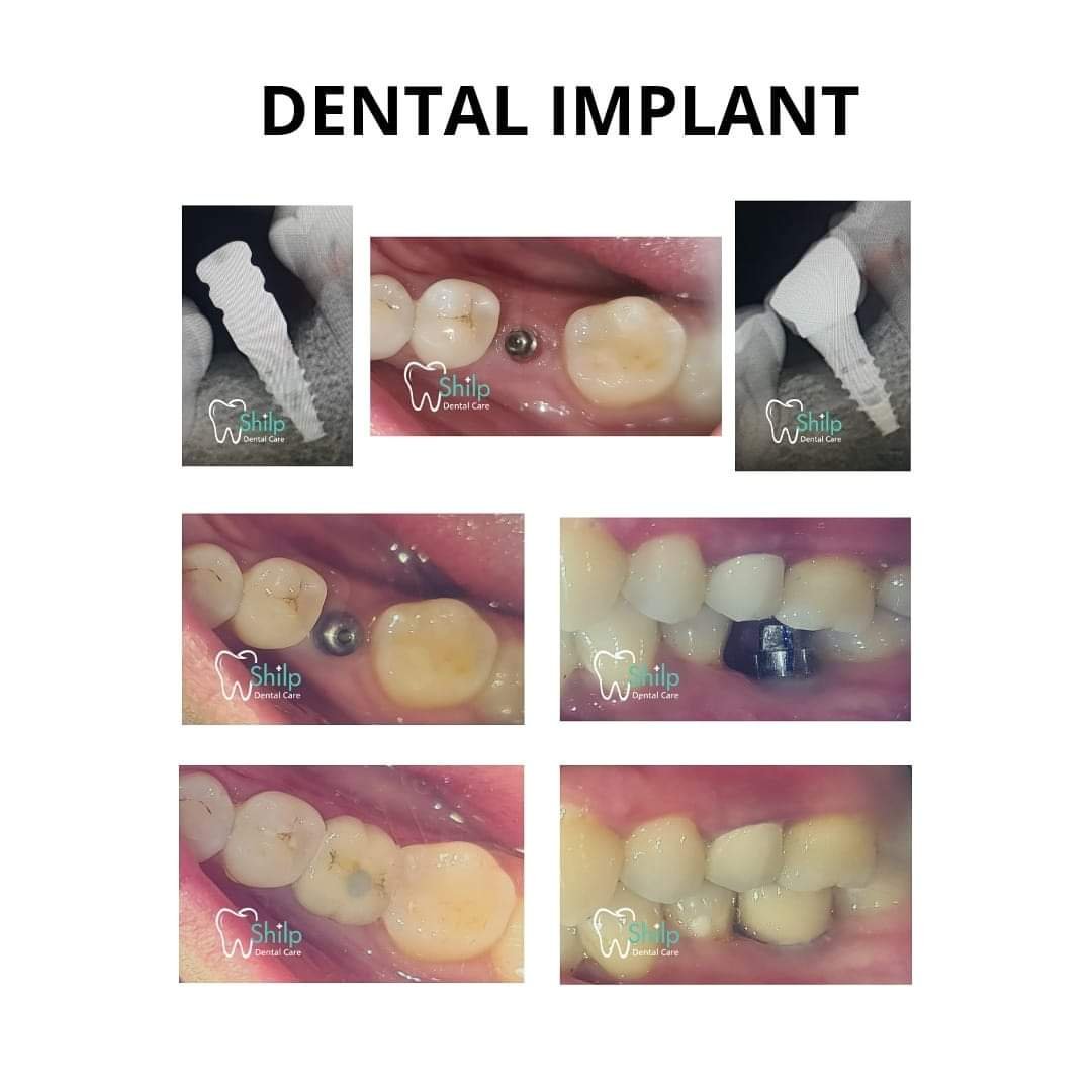 dental implant images Before