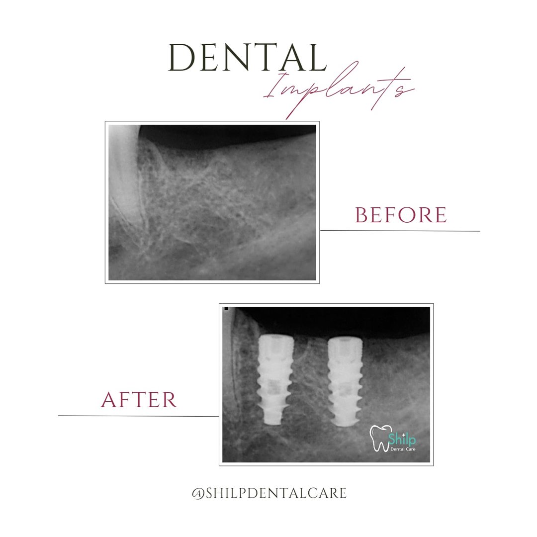 Best dental implant images Before