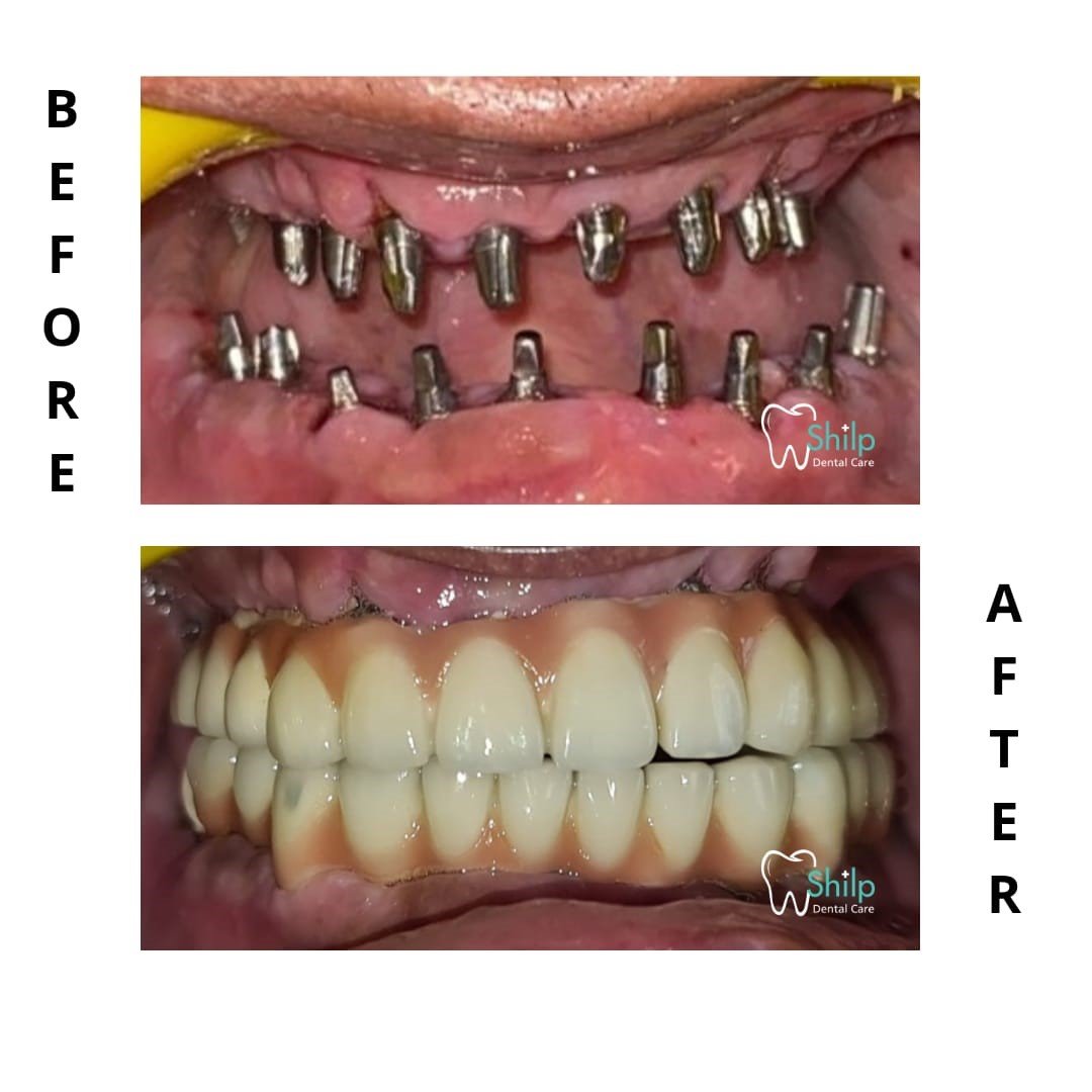 Best dental implant images After