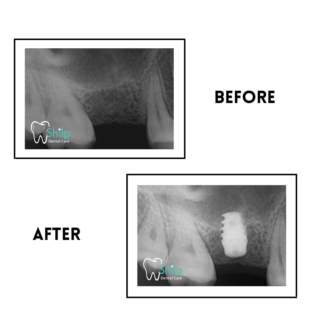 dental implant xray before