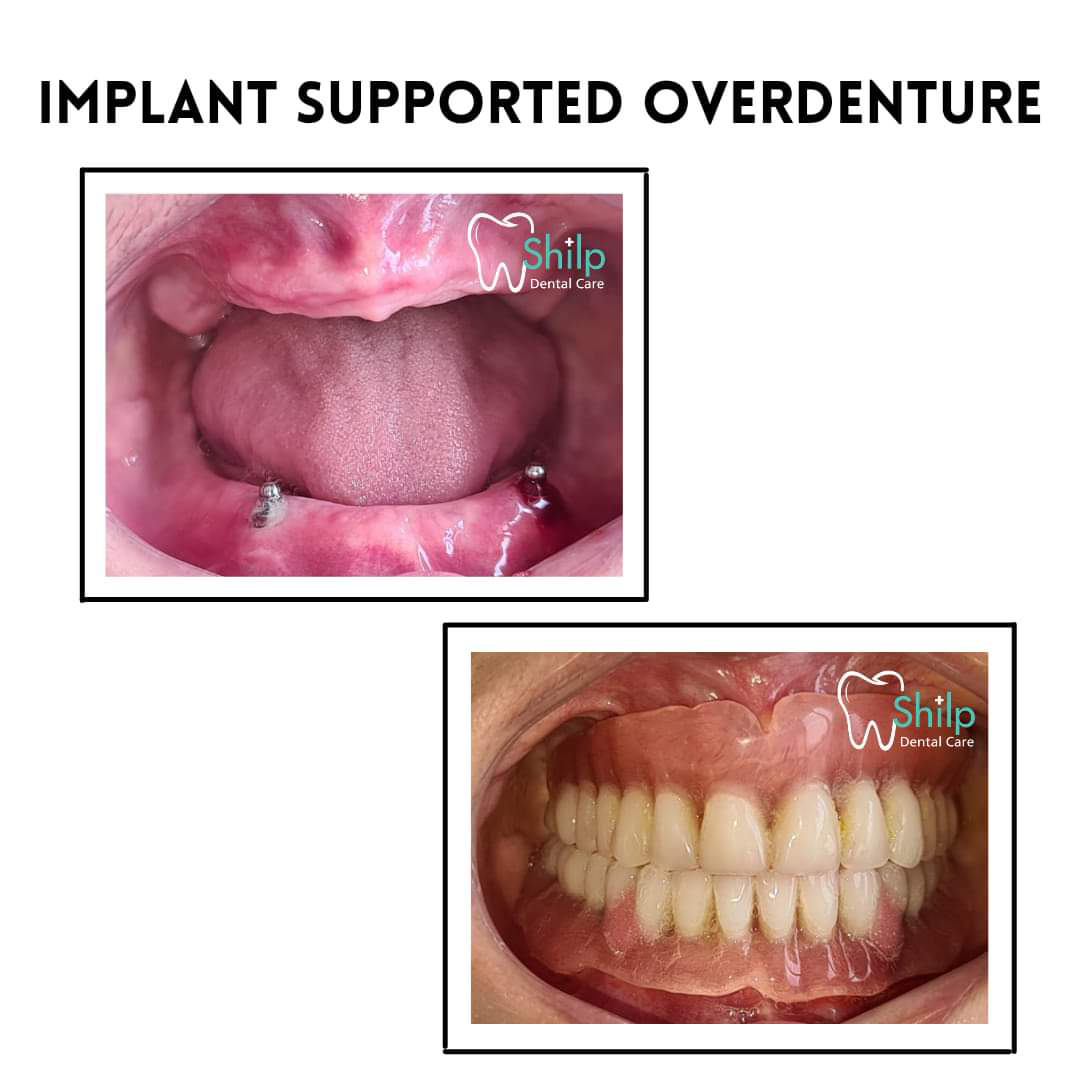 dental implant xray After