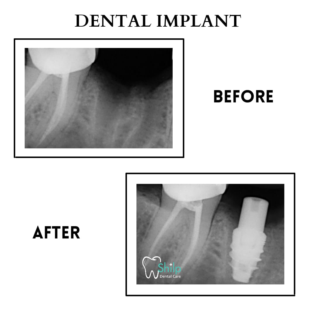 dental implant before and after