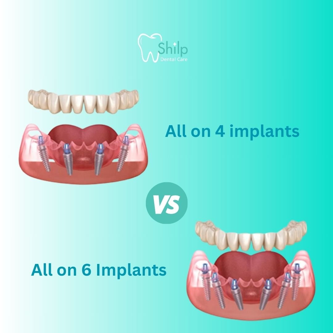 All on Six Implants at shilp dental