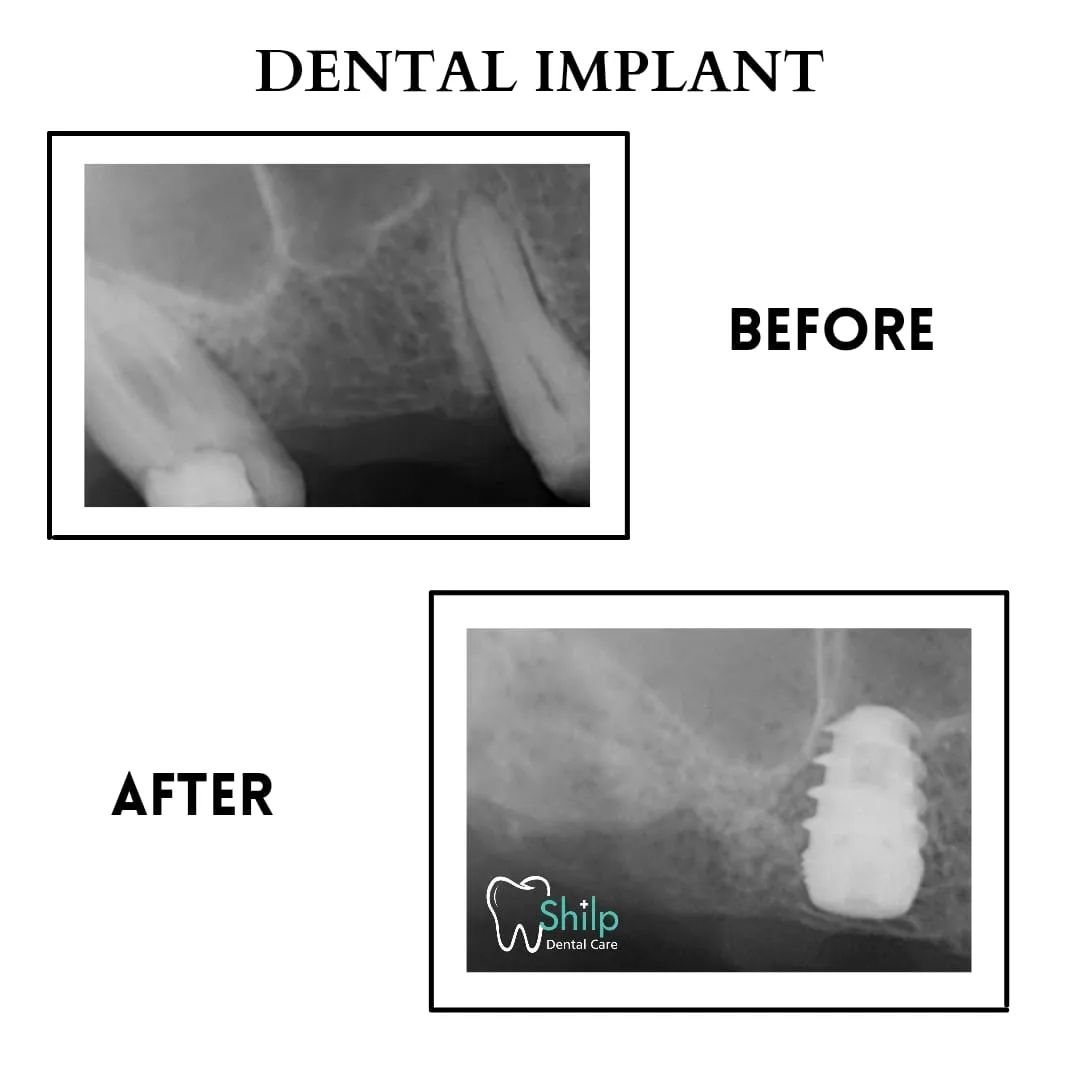 Single-Tooth-Implant