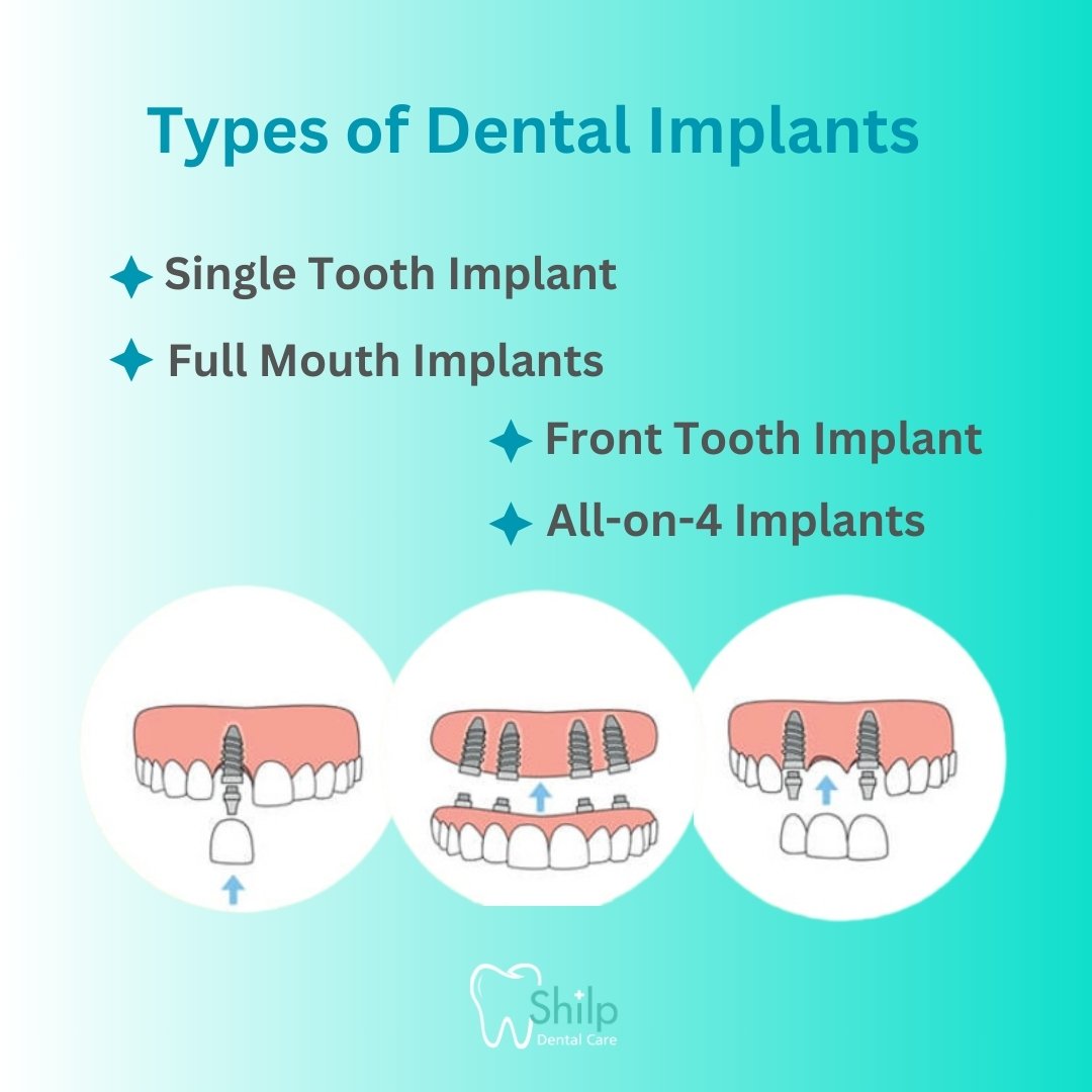 Types-of-Dental-Implants