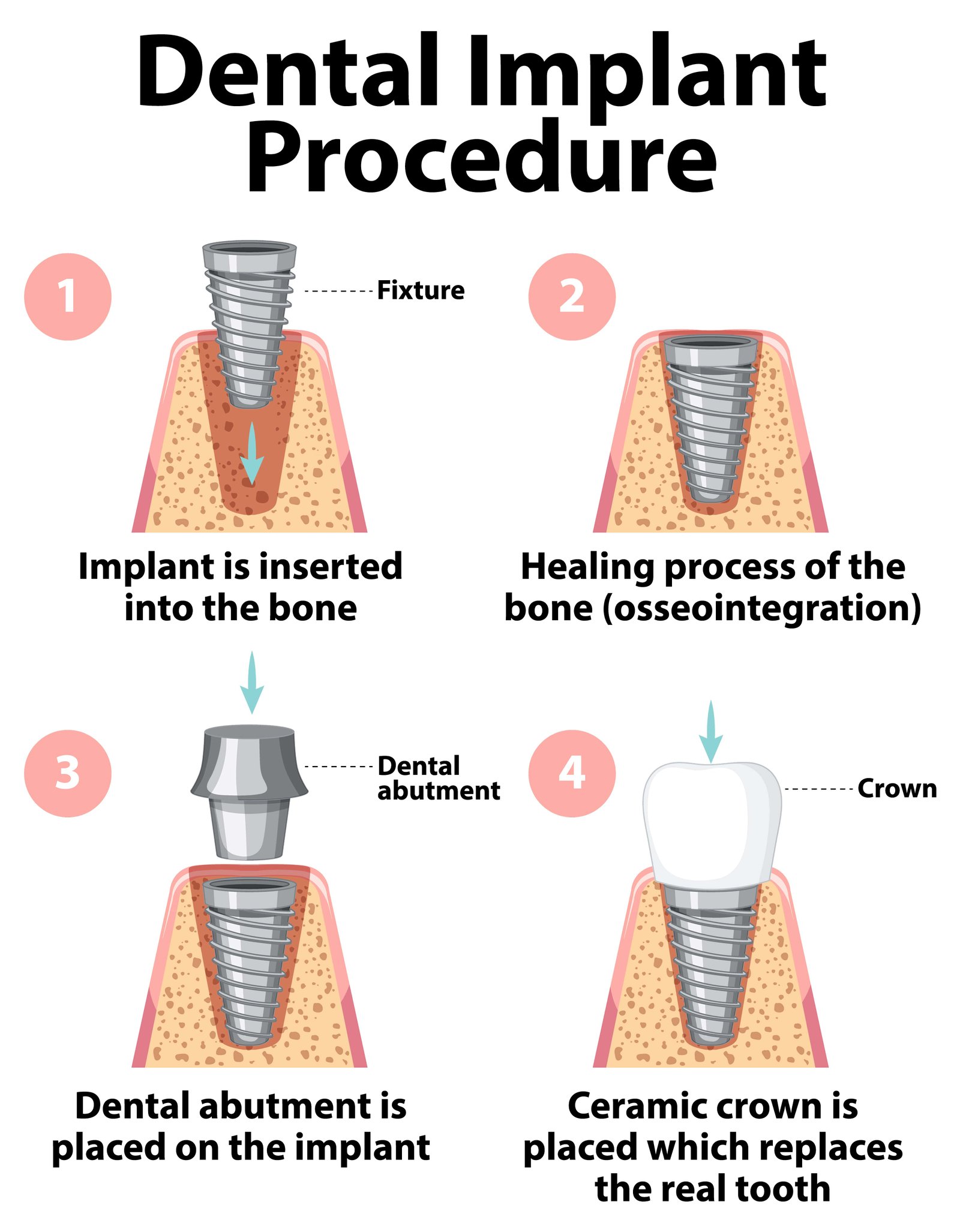 dental implant procedure