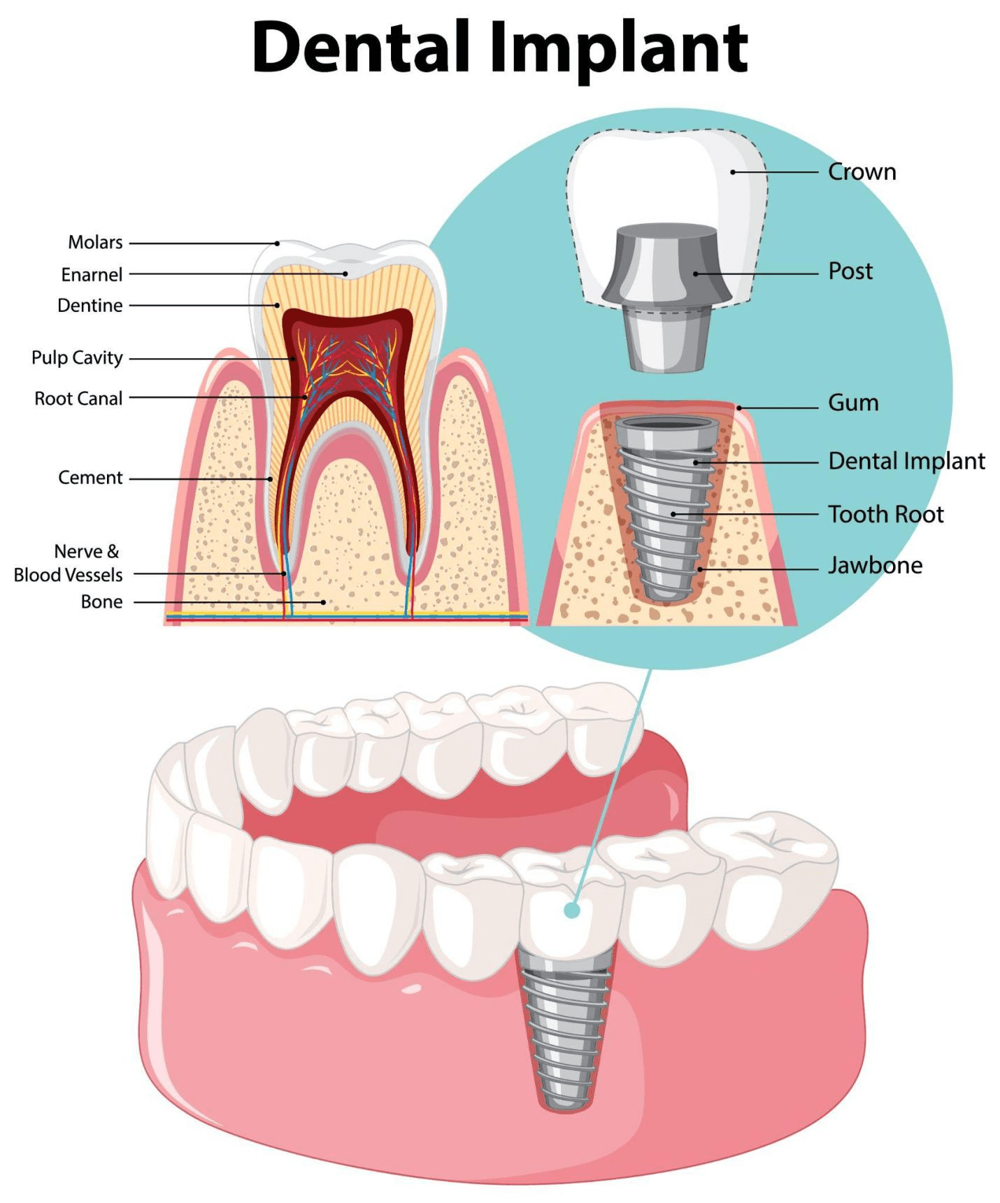 dental-implant-process