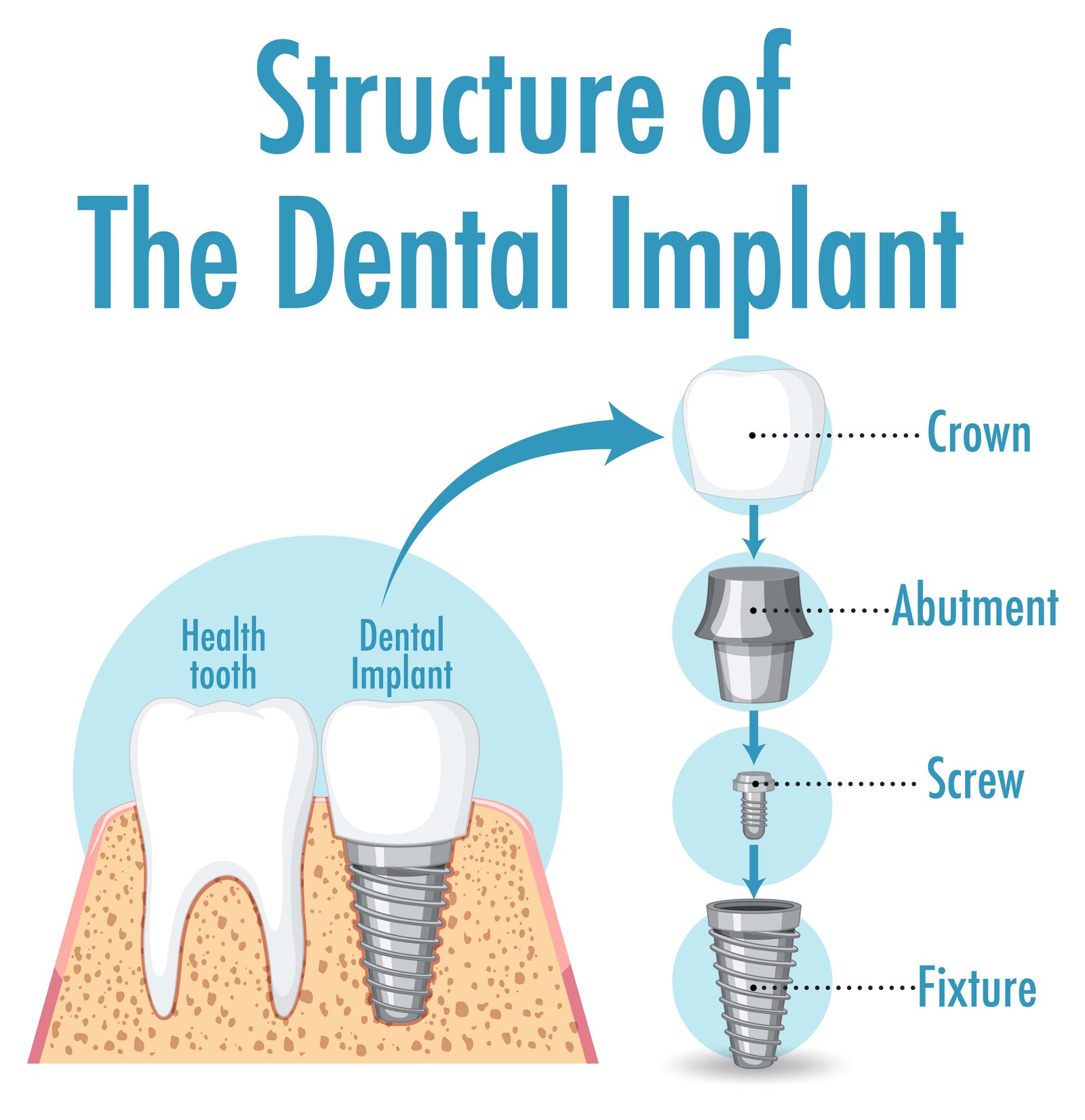 structure-dental-implant