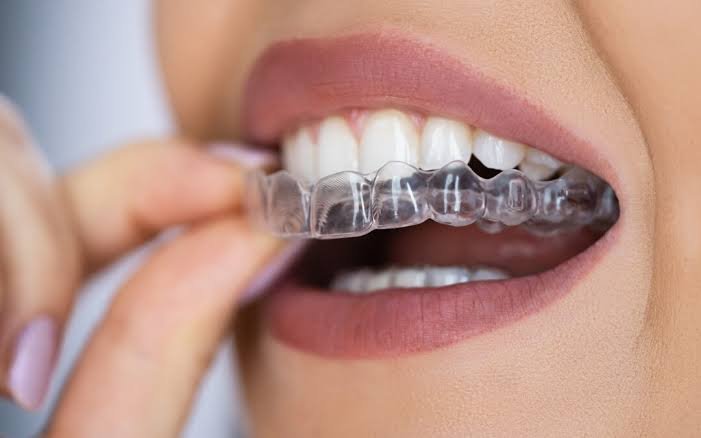 invisalign ahmedabad