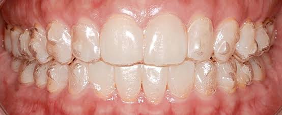 invisible braces cost in ahmedabad