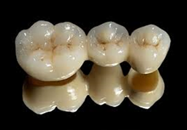 Dental Crown & Bridges