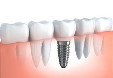 Dental Implant 