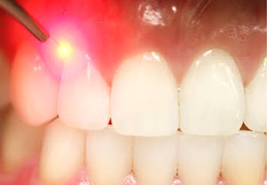 Laser Dentistry