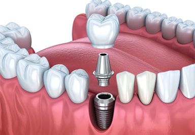 perk-dental-implant