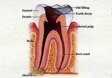 Root Canal Treatment