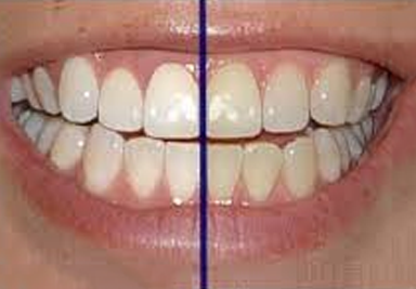 teeth-whitening